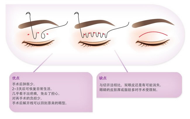 埋线双眼皮整形医院，专业塑造美丽双眼皮的新选择