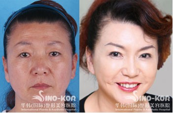韩式除皱医院，专业打造青春容颜的新选择