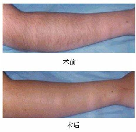北京激光脱毛医院，专业脱毛，重塑自信美丽