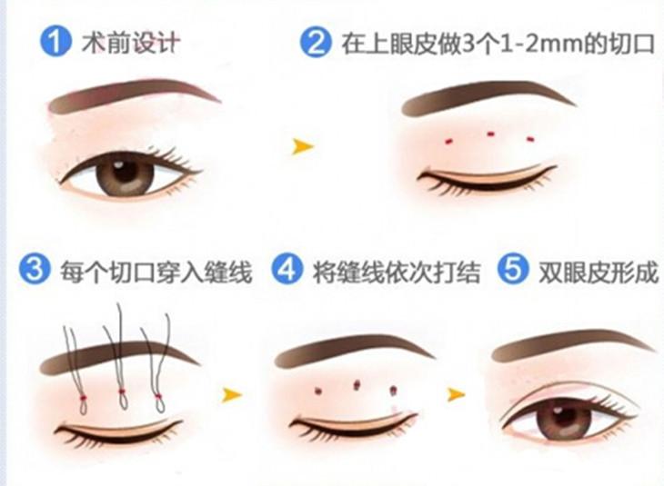 双眼皮的魅力与选择，走进顶级割双眼皮整形医院