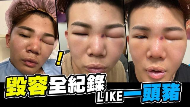 假体隆鼻医院，专业塑造美丽鼻梁