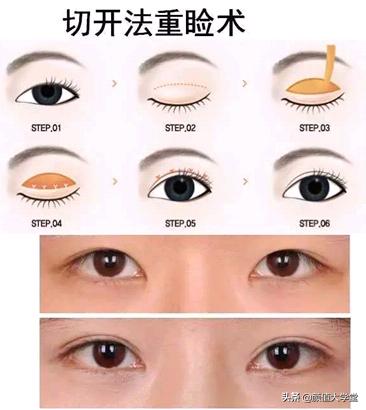 微创双眼皮手术，寻找最佳医院的选择指南