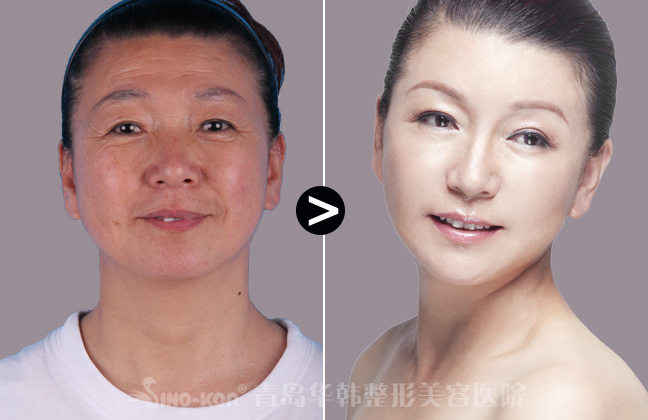 探索最佳鼻部整形之地，专业、安全、效果的完美结合