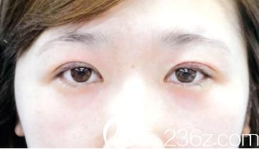 双眼皮埋线手术，探寻最佳医院的选择