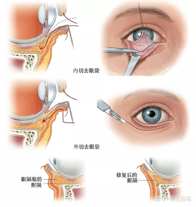 去眼袋哪家好——专业眼部美容机构深度解析