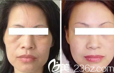 专业除皱医院，重塑青春的秘诀