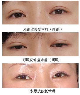 双眼皮的魅力与选择，寻找最佳的割双眼皮整形医院