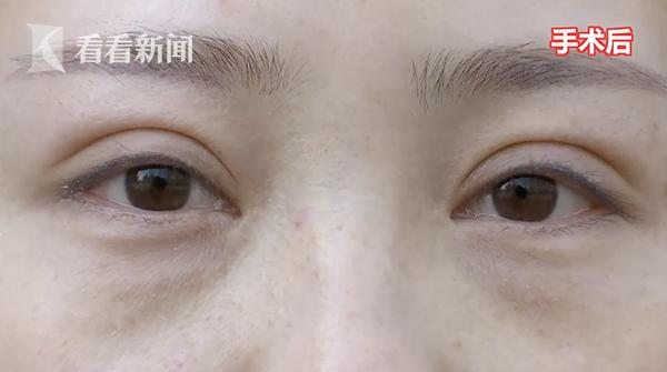 双眼皮整形手术，如何选择最佳的割双眼皮整形医院