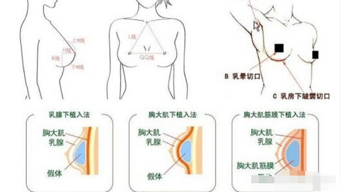 胸部整形美容医院的综合指南