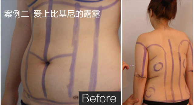 大连吸脂减肥，重塑自信美丽的新选择