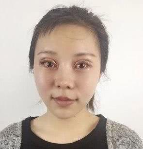 探寻最佳拉双眼皮医院，专业与安全的双重保障