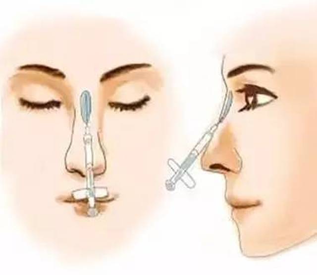 北京玻尿酸隆鼻价钱，全面解析与指导
