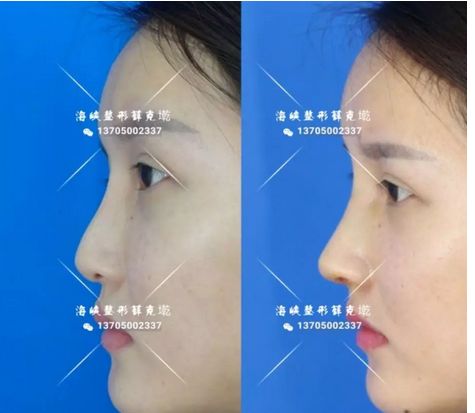华美隆鼻，重塑鼻子的艺术之美