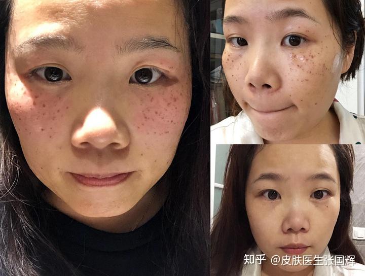激光祛斑最好的医院，专业之选，美丽之始