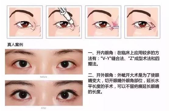 开眼角手术，如何选择最佳的医院
