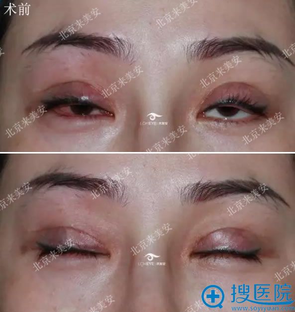 北京双眼皮修复价格解析，费用、因素与选择