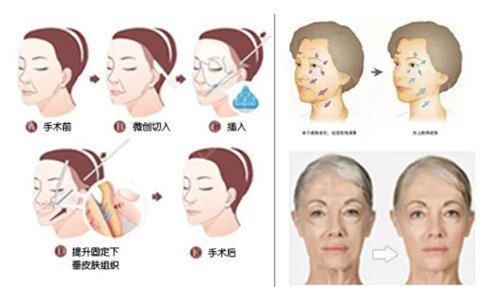 拉皮除皱医院，重塑美丽，自信人生