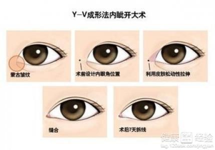 韩式开眼角手术的优势与选择