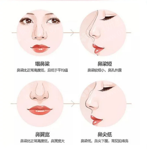 隆鼻整形医院的魅力与重要性