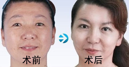 北京注射除皱哪里效果最好？专业美容机构的选择指南