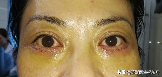 去眼袋手术医院——专业之选，重塑您的自信与美丽