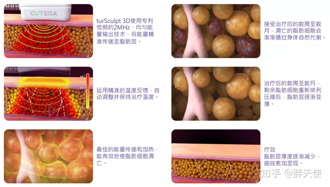 整形医院吸脂，重塑美丽，自信闪耀