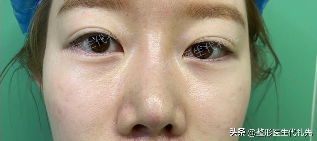 北京医院双眼皮手术，专业与信赖的选择