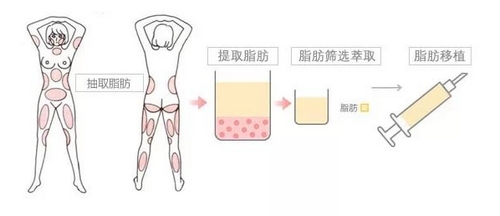 吸脂整形医院的魅力与重要性