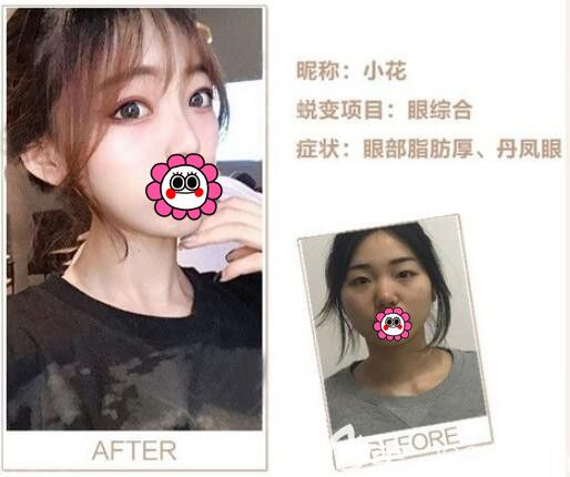眼部整形