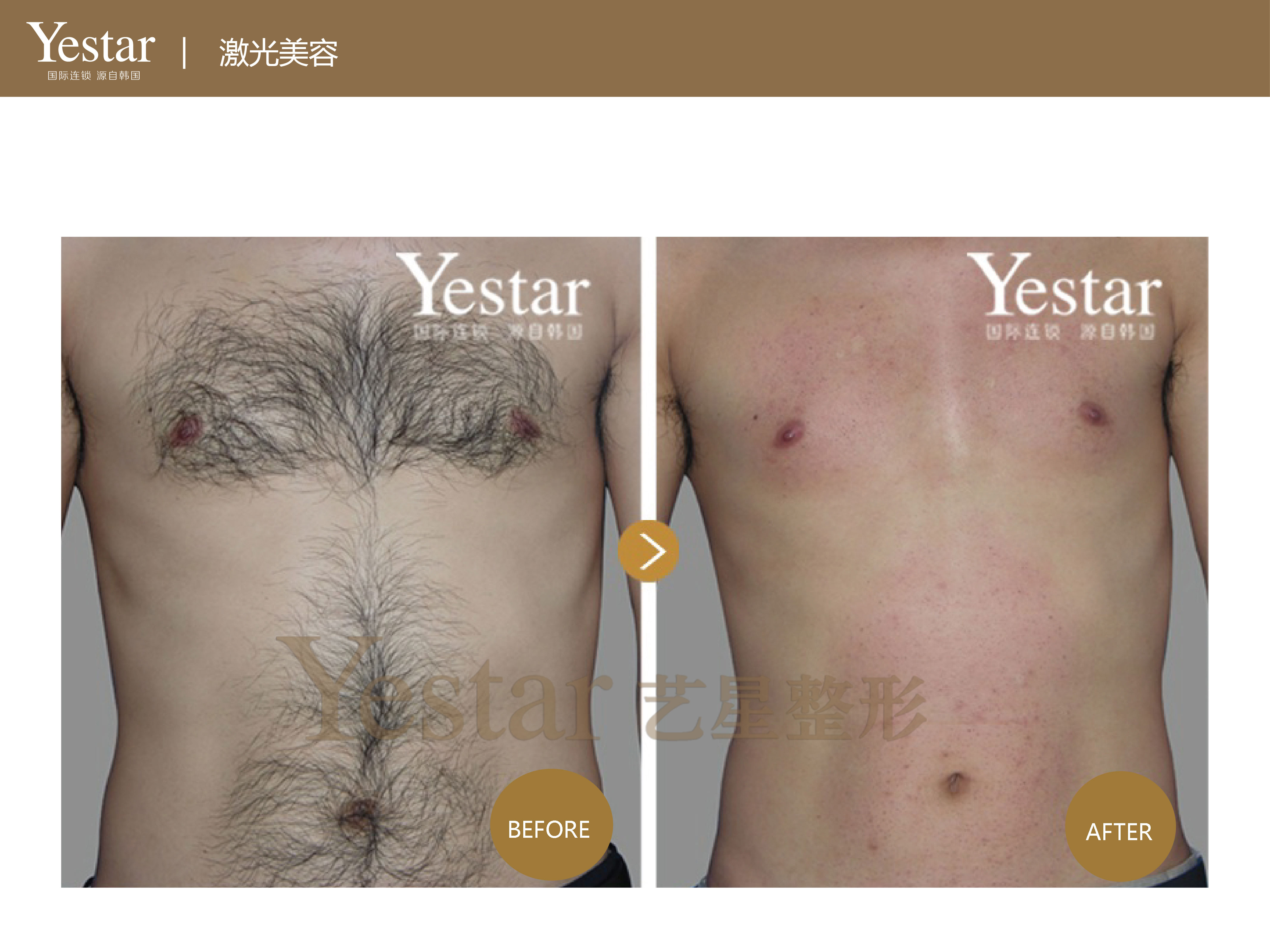 探究哪家医院脱毛效果最佳，专业脱毛机构深度解析