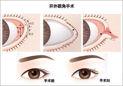 哪里做开眼角最好，专业整形美容医院的选择与考量