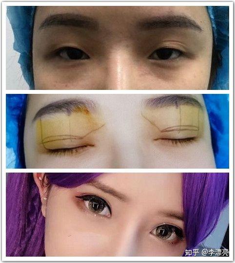 双眼皮塑造美丽视界——寻找最佳割双眼皮医院