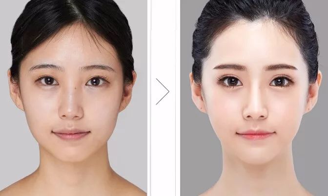 医院鼻部整形——重塑自信的完美选择