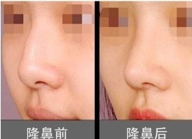 最好的假体隆鼻医院，专业塑造美丽新高度