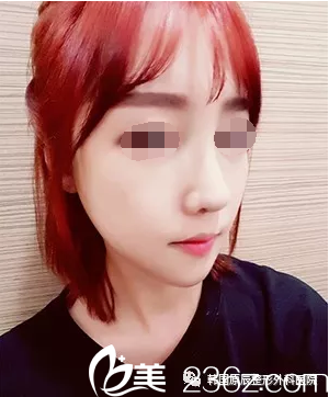 鼻部整形医院，专业塑造美丽轮廓