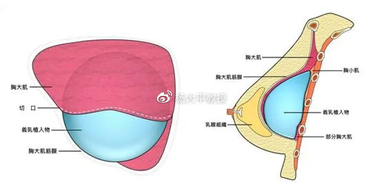假体丰胸医院的选择，专业与品质的双重考量