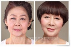 最好的除皱整形医院，专业打造无痕肌肤