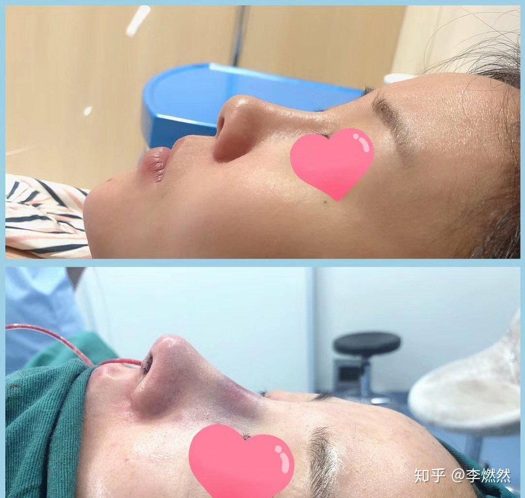关于隆鼻最好的医院的探索