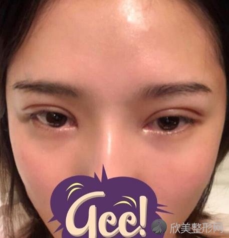 上海华美双眼皮塑造完美眼神