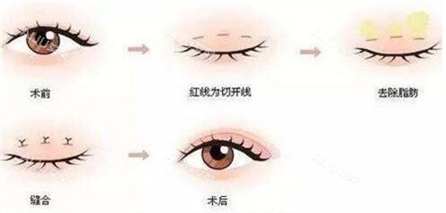北京割双眼皮价格，全面解析与指导
