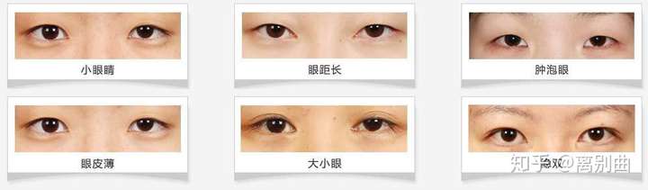 北京割双眼皮费用详解