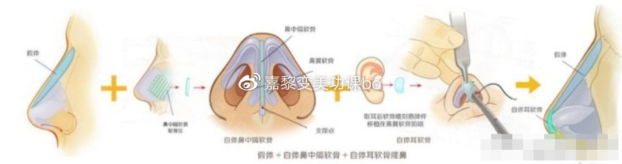 假体隆鼻手术
