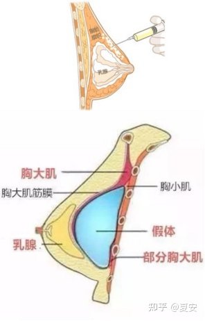隆胸修复医院哪里好的全面指南