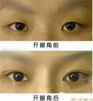 开眼角手术医院，专业之选与手术质量的关键