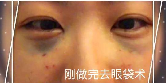 北京超声波去眼袋，重塑眼部魅力的理想选择