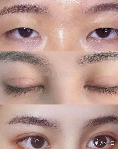双眼皮手术 第2页