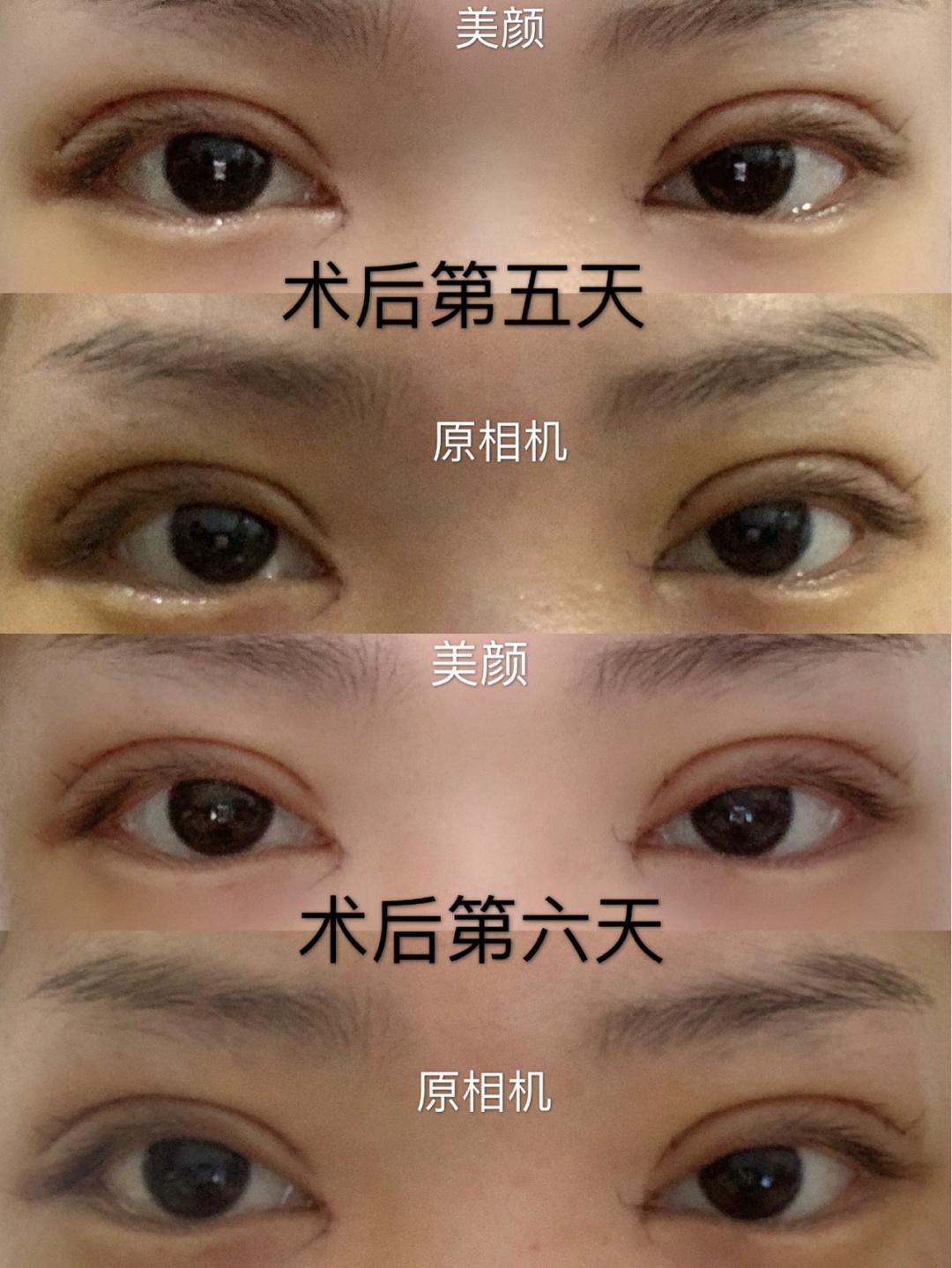 北京双眼皮手术费用详解，多少钱才合适？