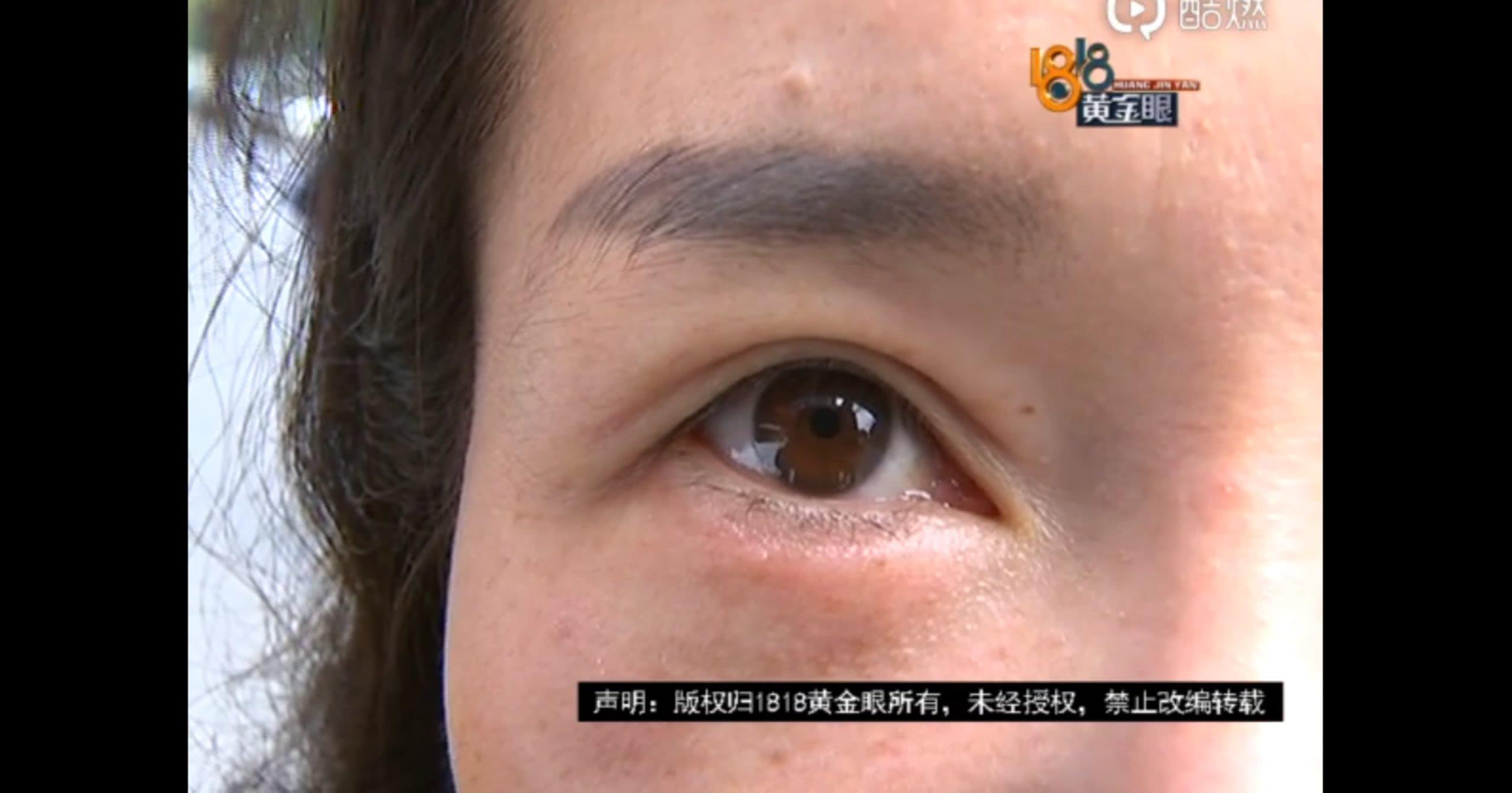 杭州割双眼皮，美丽转变的首选之地