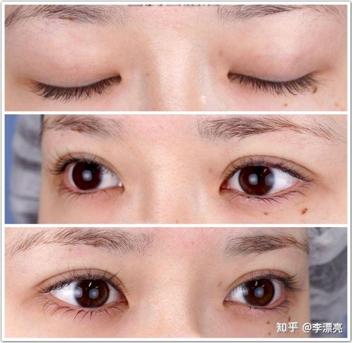 双眼皮塑造，寻找最佳的割双眼皮医院