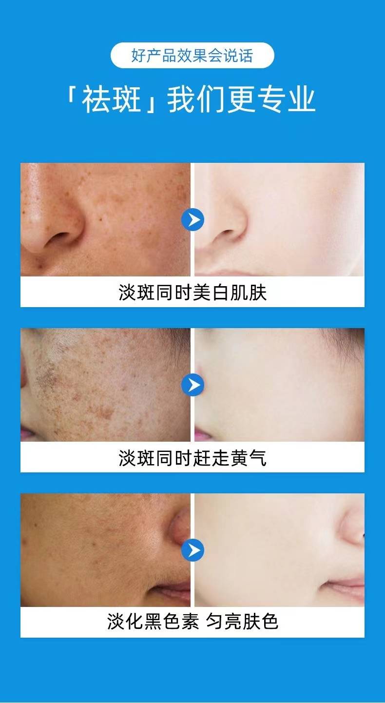 北京激光祛斑，重塑美丽脸庞的科技之选